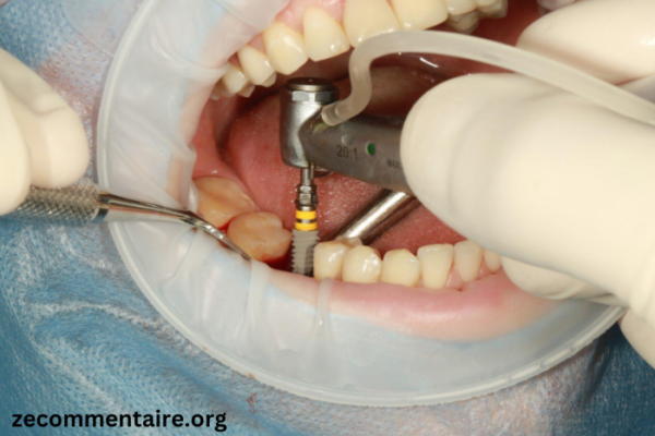 Comparing 3 Options to Replace Missing Teeth: Pros, Cons, and Cost