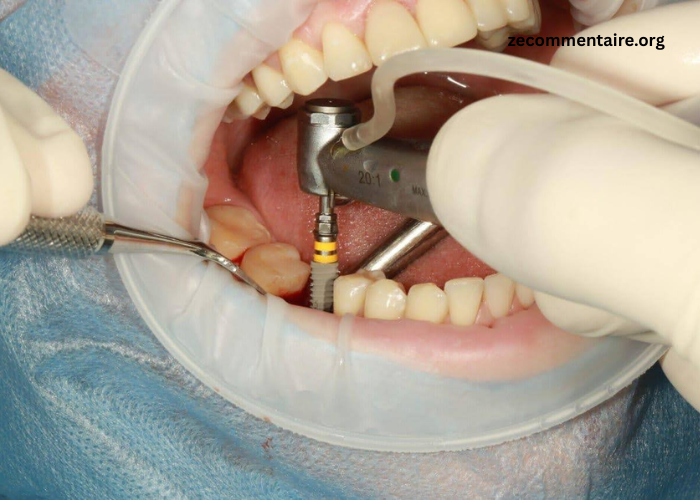 The Evolution of Dental Implants: From Past to Present
